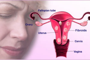 با فیبروم های رحمی در بارداری چه باید کرد؟